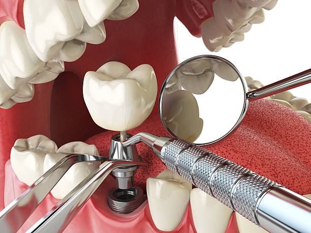 Best Emergency Tooth Extraction in Oak Grove, MS